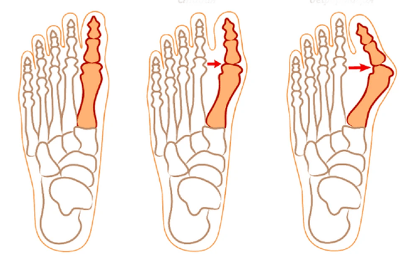 Hallux valgus deformitet