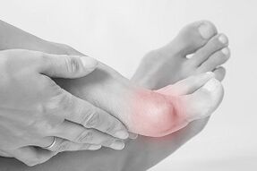 Hallux valgus kako odabrati cipele