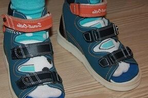 nošenje sandala za hallux valgus kod djeteta