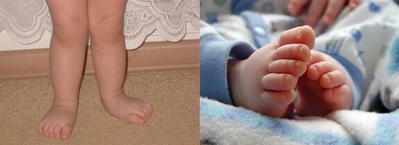 Valgus deformacija stopala