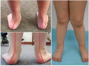 Valgus